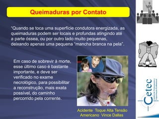 Queimaduras por Contato
“Quando se toca uma superfície condutora energizada, as
queimaduras podem ser locais e profundas atingindo até
a parte óssea, ou por outro lado muito pequenas,
deixando apenas uma pequena “mancha branca na pela”.
Em caso de sobrevir à morte,
esse último caso é bastante
importante, e deve ser
verificado no exame
necrológico, para possibilitar
a reconstrução, mais exata
possível, do caminho
percorrido pela corrente.
Acidente Toque Alta Tensão
Americano Vince Dallas
 