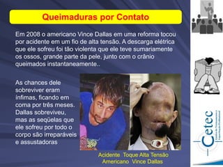 Em 2008 o americano Vince Dallas em uma reforma tocou
por acidente em um fio de alta tensão. A descarga elétrica
que ele sofreu foi tão violenta que ele teve sumariamente
os ossos, grande parte da pele, junto com o crânio
queimados instantaneamente..
Queimaduras por Contato
As chances dele
sobreviver eram
ínfimas, ficando em
coma por três meses.
Dallas sobreviveu,
mas as seqüelas que
ele sofreu por todo o
corpo são irreparáveis
e assustadoras
Acidente Toque Alta Tensão
Americano Vince Dallas
 