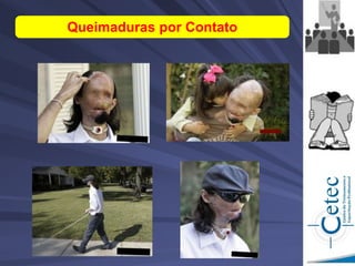 Queimaduras por Contato
 