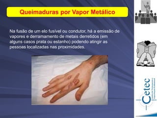 Na fusão de um elo fusível ou condutor, há a emissão de
vapores e derramamento de metais derretidos (em
alguns casos prata ou estanho) podendo atingir as
pessoas localizadas nas proximidades.
Queimaduras por Vapor Metálico
 