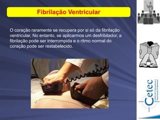 O coração raramente se recupera por si só da fibrilação
ventricular. No entanto, se aplicarmos um desfribilador, a
fibrilação pode ser interrompida e o ritmo normal do
coração pode ser restabelecido.
Fibrilação Ventricular
 