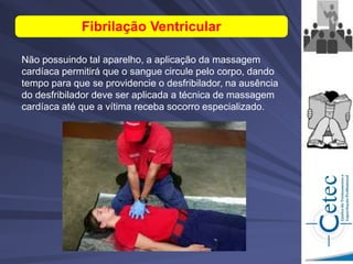Não possuindo tal aparelho, a aplicação da massagem
cardíaca permitirá que o sangue circule pelo corpo, dando
tempo para que se providencie o desfribilador, na ausência
do desfribilador deve ser aplicada a técnica de massagem
cardíaca até que a vítima receba socorro especializado.
Fibrilação Ventricular
 