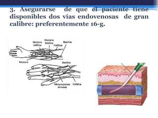 3. Asegurarse de que el paciente tiene
disponibles dos vías endovenosas de gran
calibre: preferentemente 16-g.
 