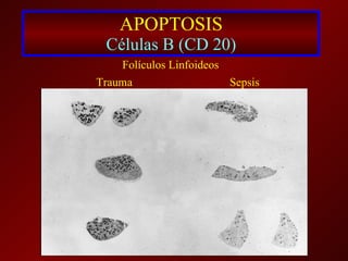 APOPTOSIS Células B (CD 20) Folículos Linfoideos Trauma Sepsis 