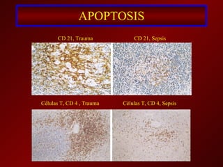 APOPTOSIS CD 21, Trauma CD 21, Sepsis Células T, CD 4 , Trauma Células T, CD 4, Sepsis 
