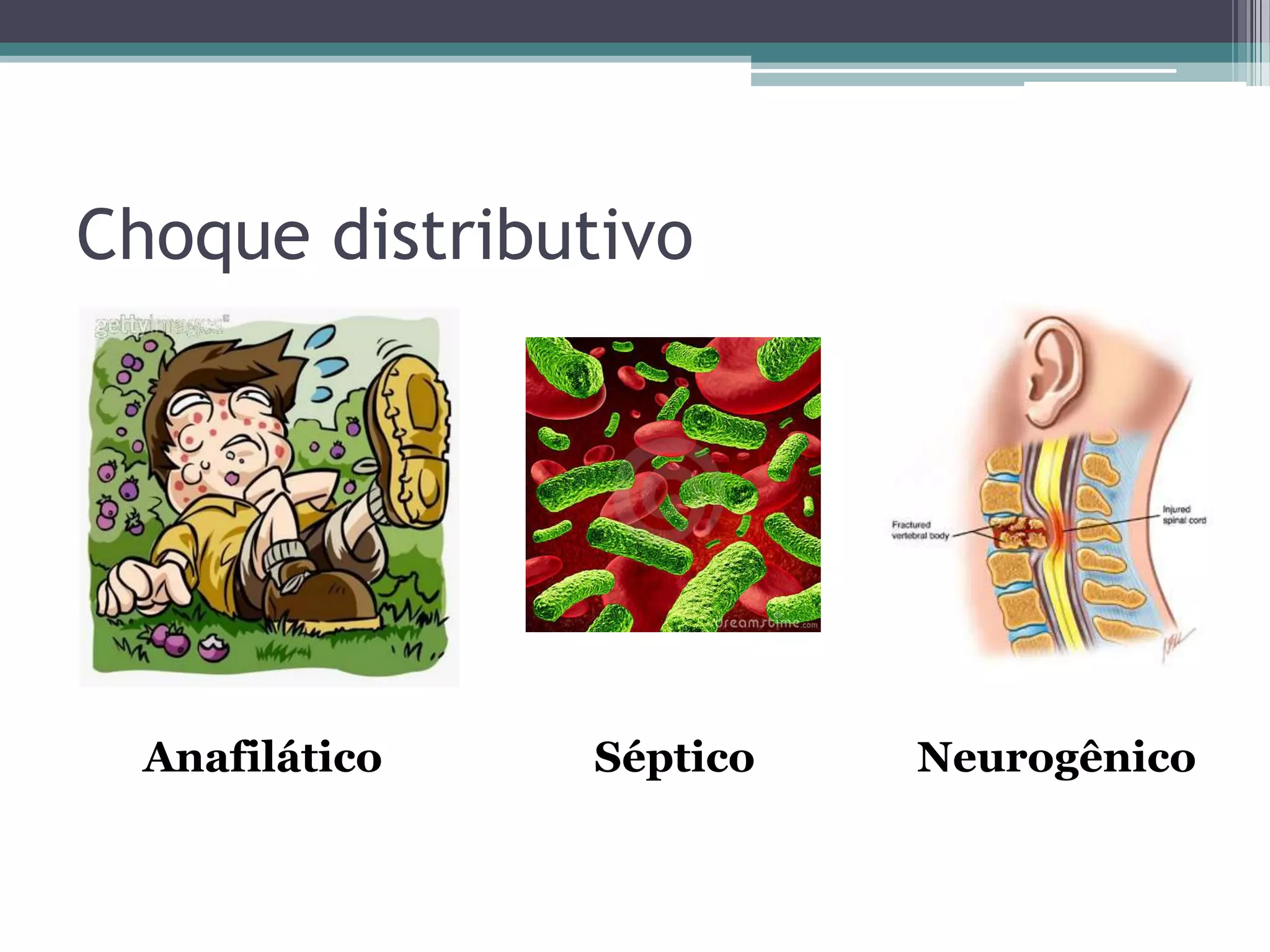 Choque distributivo
Anafilático Séptico Neurogênico
 
