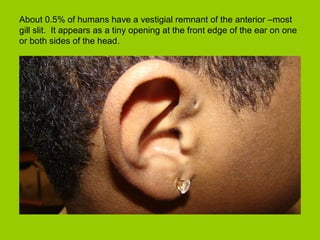 About 0.5% of humans have a vestigial remnant of the anterior –most
gill slit. It appears as a tiny opening at the front edge of the ear on one
or both sides of the head.
 