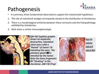 SAKRA INSTITUTE OF NEUROSCIENCES
• In summary, three fundamental observations support the notochordal hypothesis:
1. The site of notochord vestiges corresponds closely to the distribution of chordomas;
2. There is a morphological similarity between these remnants and the histopathology
exhibited by chordomas;
3. Both share a similar immunophenotype
Pathogenesis
 