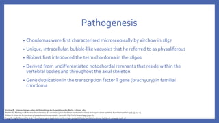 Pathogenesis
• Chordomas were first characterised microscopically byVirchow in 1857
• Unique, intracellular, bubble-like vacuoles that he referred to as physaliferous
• Ribbert first introduced the term chordoma in the 1890s
• Derived from undifferentiated notochordal remnants that reside within the
vertebral bodies and throughout the axial skeleton
• Gene duplication in the transcription factorT gene (brachyury) in familial
chordoma
Virchow RL. Untersuchungen ueber die Entwicklung des Schaedelgrundes. Berlin: G Rimer, 1857.
Horten BC, Montague SR. In vitro characteristics of a sacrococcygeal chordoma maintained in tissue and organ culture systems. Acta Neuropathol 1976; 35: 13–25.
Ribbert H. Uber die Ecchondosis physaliphora phenooccipitalis. Centralbl Allg Pathol Anat 1894; 5: 457–61
Yang XR, Ng D, Alcorta DA, et al. T (brachyury) gene duplication confers major susceptibility to familial chordoma. Nat Genet 2009; 41: 1176–78
 
