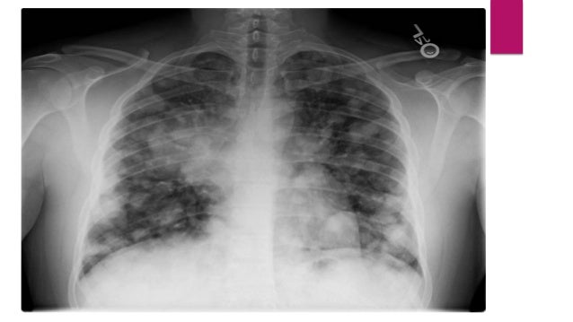 Choriocarcinoma and its management