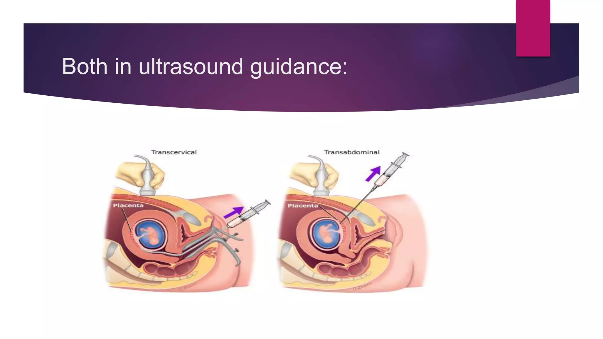 Chorionic Villus Sampling Near Me – Accurate Diagnosis for Fetal Health