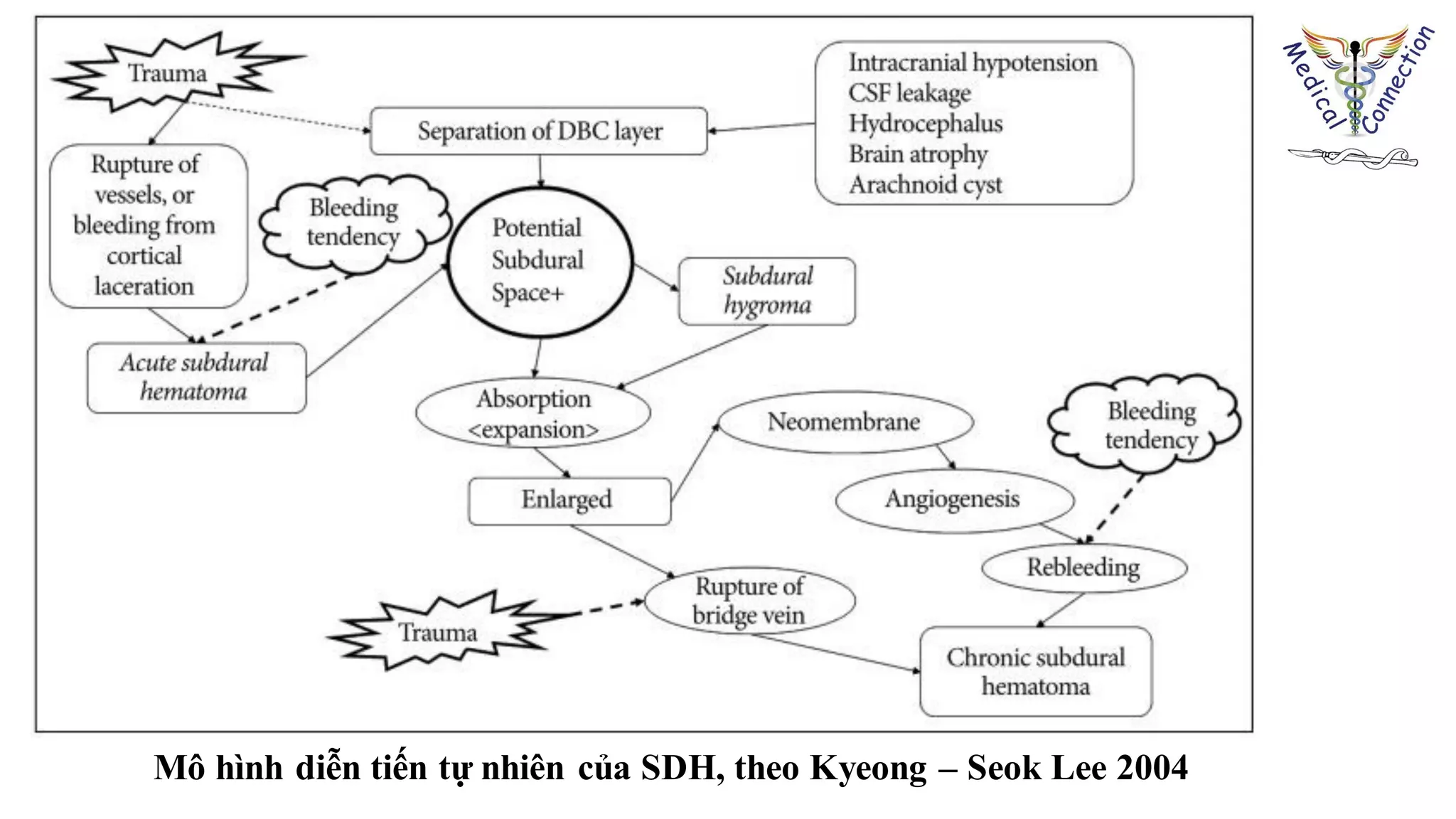 Mô hình diễn tiến tự nhiên của SDH, theo Kyeong – Seok Lee 2004
 