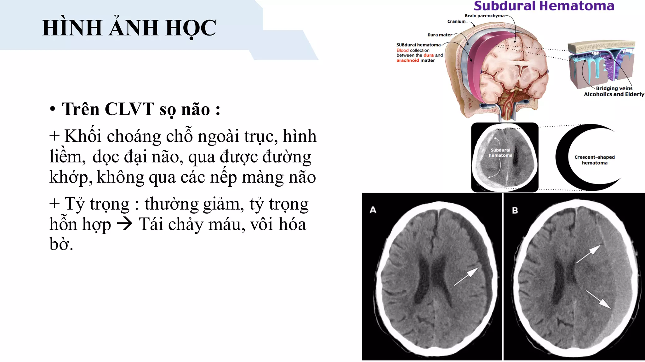 HÌNH ẢNH HỌC
• Trên CLVT sọ não :
+ Khối choáng chỗ ngoài trục, hình
liềm, dọc đại não, qua được đường
khớp, không qua các nếp màng não
+ Tỷ trọng : thường giảm, tỷ trọng
hỗn hợp  Tái chảy máu, vôi hóa
bờ.
 