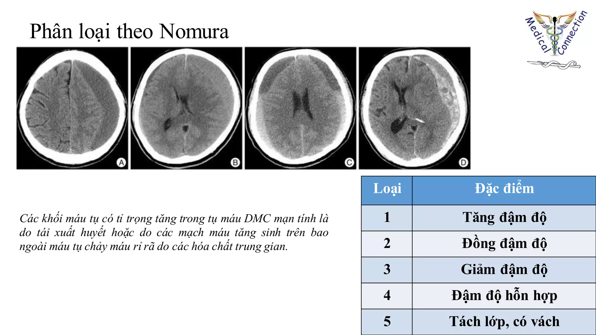 Loại Đặc điểm
1 Tăng đậm độ
2 Đồng đậm độ
3 Giảm đậm độ
4 Đậm độ hỗn hợp
5 Tách lớp, có vách
Phân loại theo Nomura
Các khối máu tụ có tỉ trọng tăng trong tụ máu DMC mạn tính là
do tái xuất huyết hoặc do các mạch máu tăng sinh trên bao
ngoài máu tụ chảy máu rỉ rã do các hóa chất trung gian.
 
