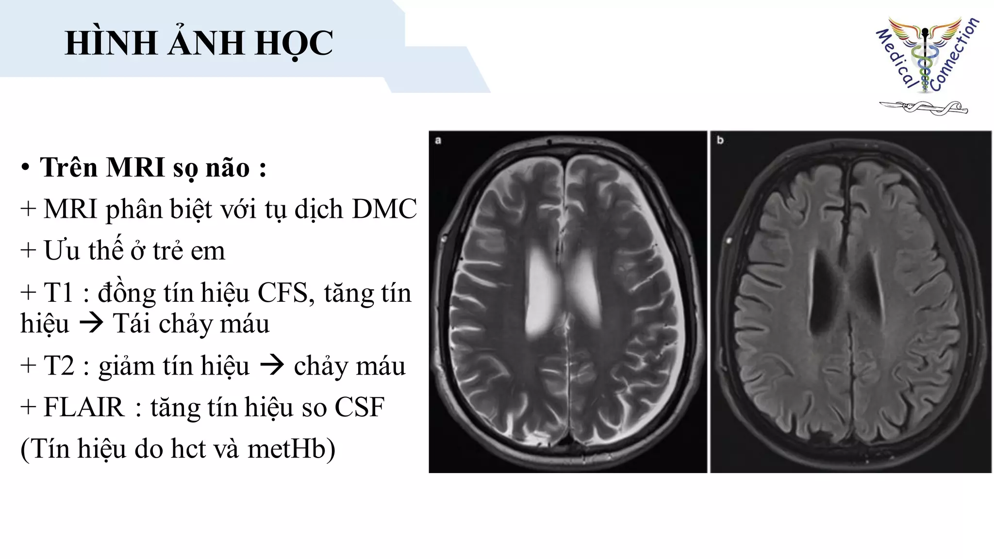 • Trên MRI sọ não :
+ MRI phân biệt với tụ dịch DMC
+ Ưu thế ở trẻ em
+ T1 : đồng tín hiệu CFS, tăng tín
hiệu  Tái chảy máu
+ T2 : giảm tín hiệu  chảy máu
+ FLAIR : tăng tín hiệu so CSF
(Tín hiệu do hct và metHb)
HÌNH ẢNH HỌC
 