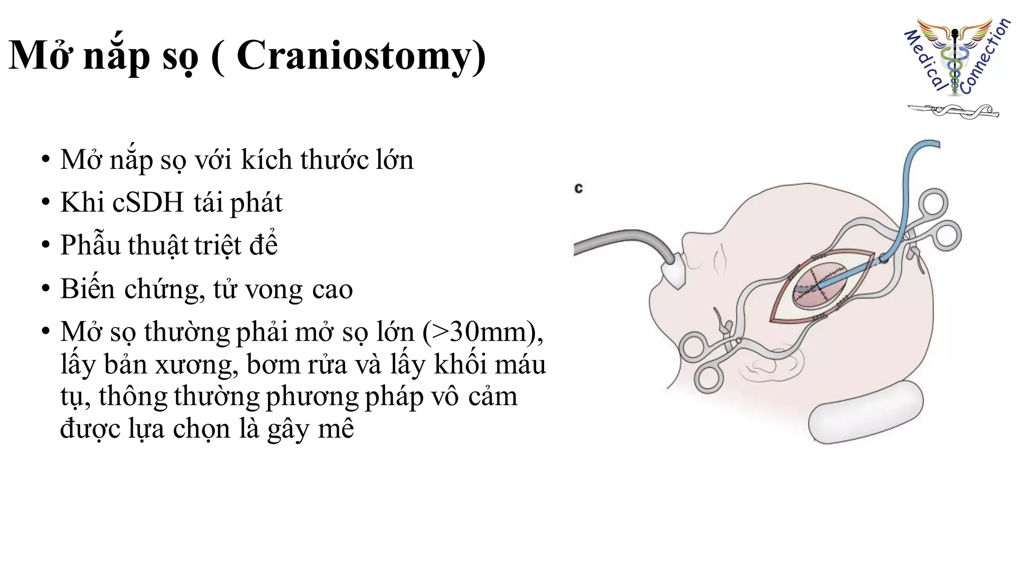 • Mở nắp sọ với kích thước lớn
• Khi cSDH tái phát
• Phẫu thuật triệt để
• Biến chứng, tử vong cao
• Mở sọ thường phải mở sọ lớn (>30mm),
lấy bản xương, bơm rửa và lấy khối máu
tụ, thông thường phương pháp vô cảm
được lựa chọn là gây mê
Mở nắp sọ ( Craniostomy)
 