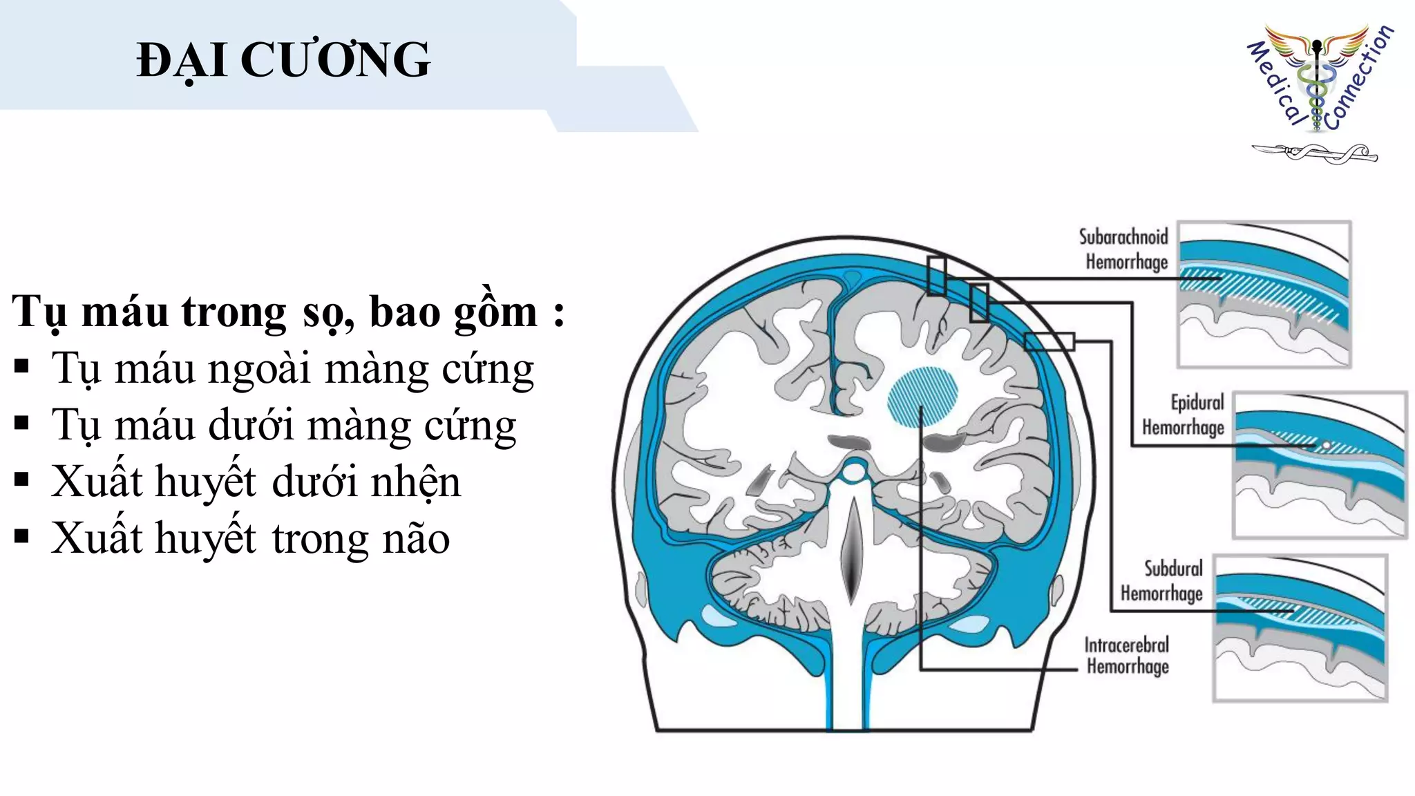 ĐẠI CƯƠNG
Tụ máu trong sọ, bao gồm :
 Tụ máu ngoài màng cứng
 Tụ máu dưới màng cứng
 Xuất huyết dưới nhện
 Xuất huyết trong não
ĐẠI CƯƠNG
 
