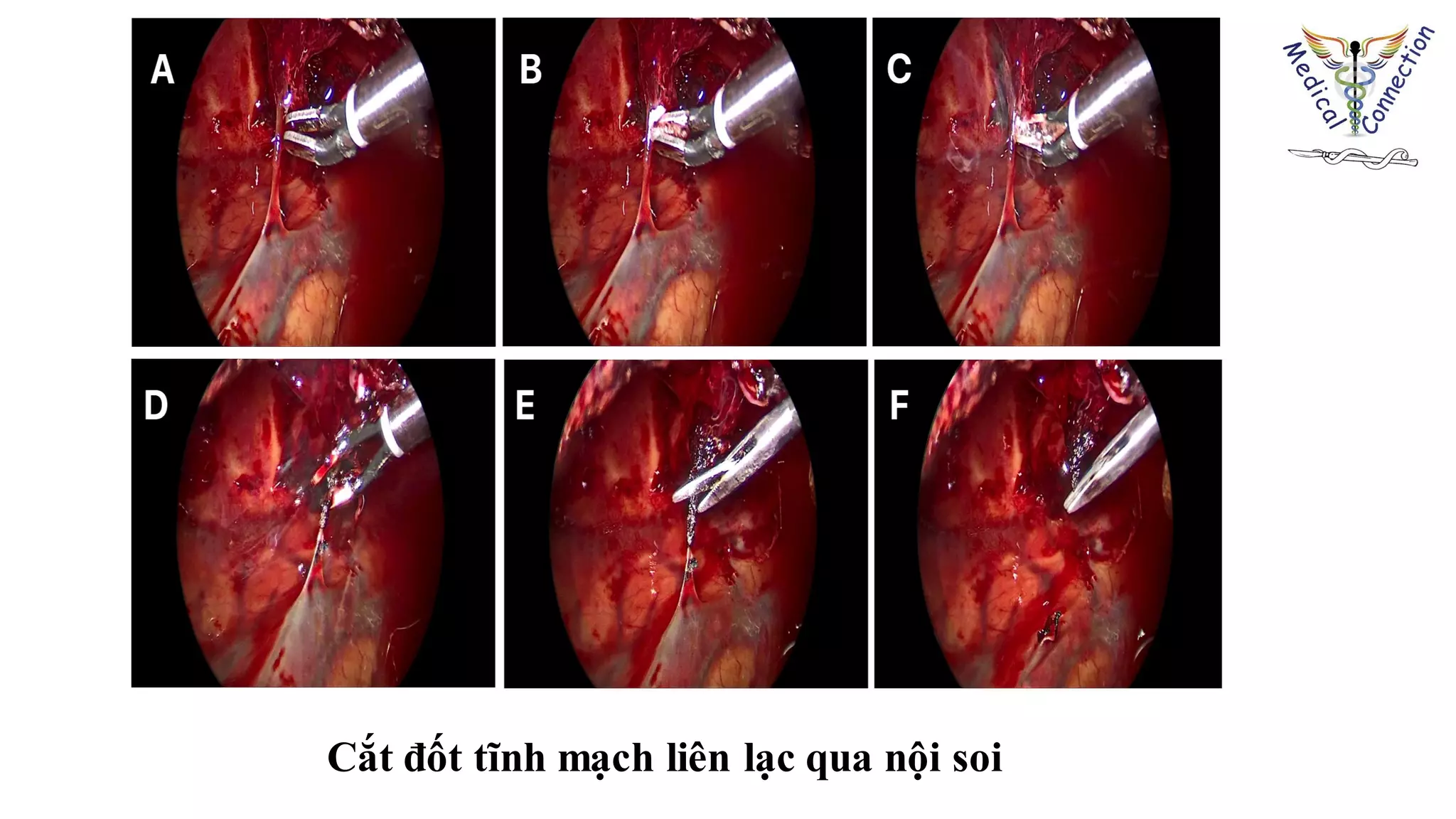 Cắt đốt tĩnh mạch liên lạc qua nội soi
 