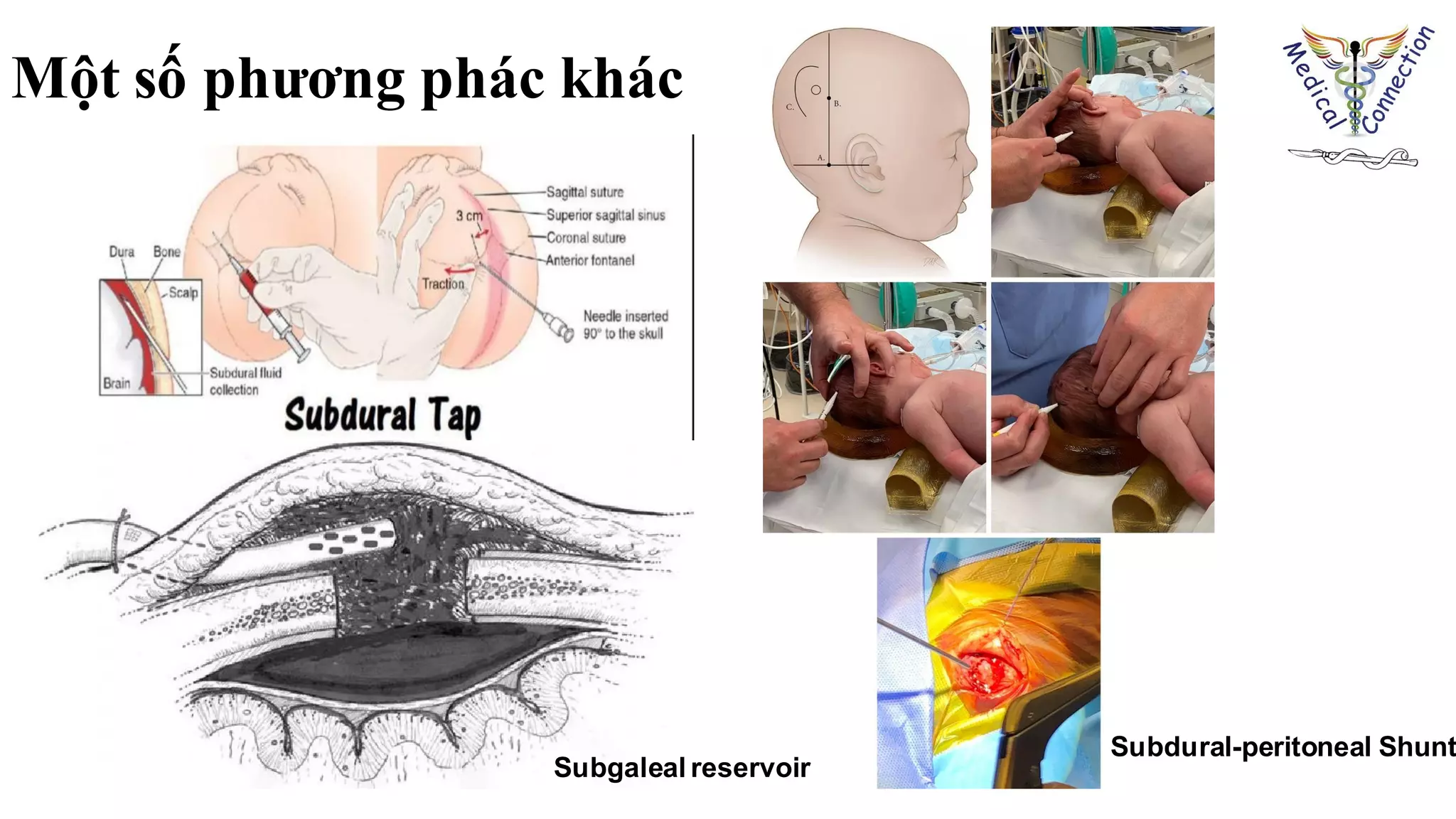 Một số phương phác khác
Subgaleal reservoir
Subdural-peritoneal Shunt
 