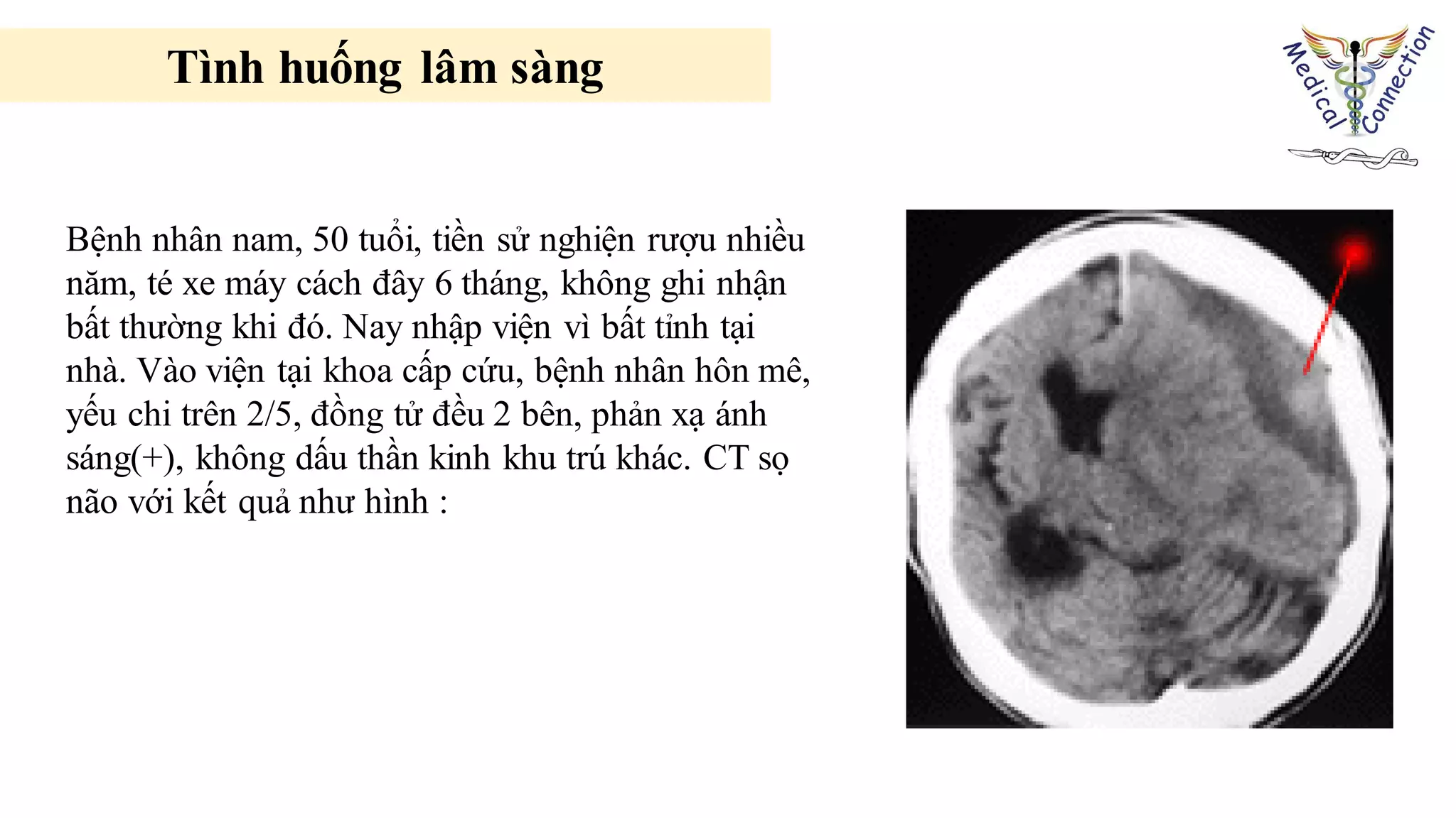 Bệnh nhân nam, 50 tuổi, tiền sử nghiện rượu nhiều
năm, té xe máy cách đây 6 tháng, không ghi nhận
bất thường khi đó. Nay nhập viện vì bất tỉnh tại
nhà. Vào viện tại khoa cấp cứu, bệnh nhân hôn mê,
yếu chi trên 2/5, đồng tử đều 2 bên, phản xạ ánh
sáng(+), không dấu thần kinh khu trú khác. CT sọ
não với kết quả như hình :
Tình huống lâm sàng
 
