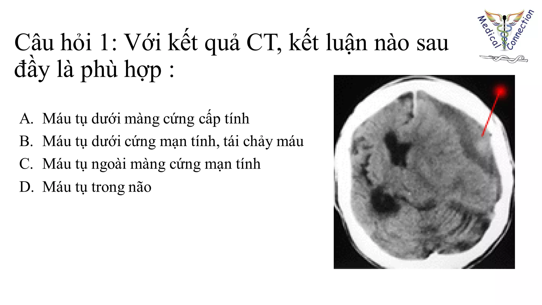 Câu hỏi 1: Với kết quả CT, kết luận nào sau
đầy là phù hợp :
A. Máu tụ dưới màng cứng cấp tính
B. Máu tụ dưới cứng mạn tính, tái chảy máu
C. Máu tụ ngoài màng cứng mạn tính
D. Máu tụ trong não
 