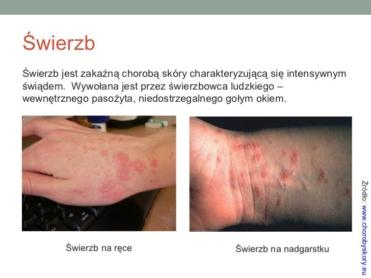 Podaj Cztery Różne Propozycje Dotyczące Profilaktyki Chorób Skóry Choroby skóry