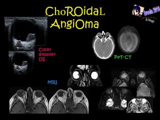 ChoROidaL
AngiOma
Color
doppler
US
PeT-CT
MRI
 