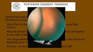 Vortex Detachment Choroidal detachment -Nov 2017 | PPTX