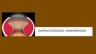 SUPRACHOROIDAL HEMORRHAGE
 