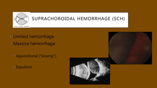 SUPRACHOROIDAL HEMORRHAGE (SCH)
• Limited hemorrhage
• Massive hemorrhage
• Appositional (“kissing”).
• Expulsive
 
