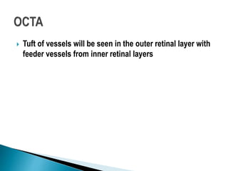  Tuft of vessels will be seen in the outer retinal layer with
feeder vessels from inner retinal layers
 