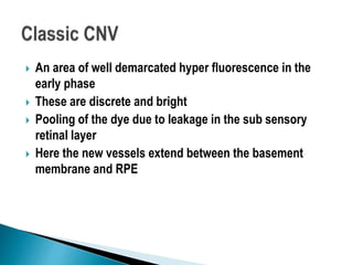  An area of well demarcated hyper fluorescence in the
early phase
 These are discrete and bright
 Pooling of the dye due to leakage in the sub sensory
retinal layer
 Here the new vessels extend between the basement
membrane and RPE
 