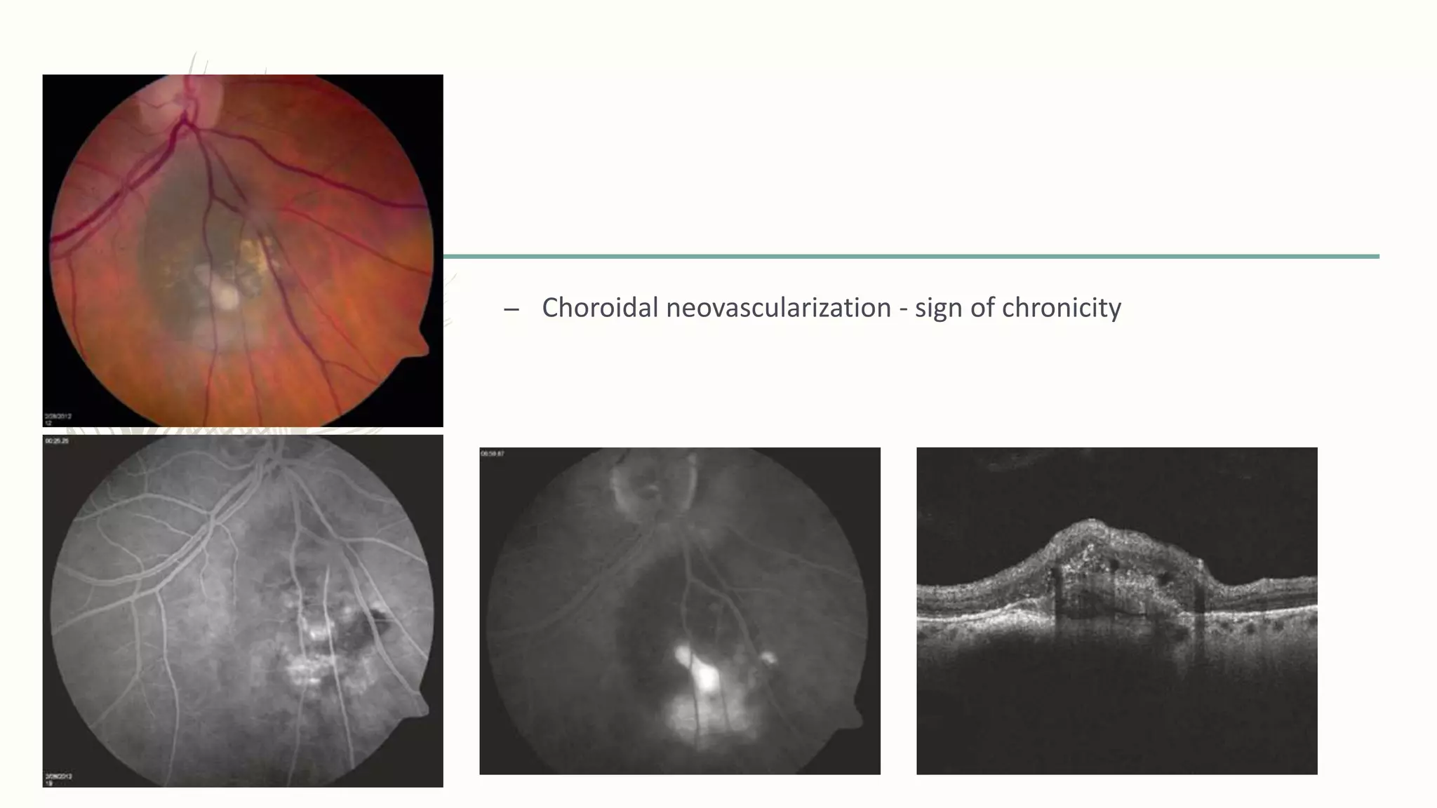 Choroidal nevus and chrpe | PPTX