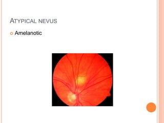 ATYPICAL NEVUS
 Amelanotic
 