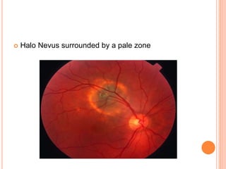  Halo Nevus surrounded by a pale zone
 