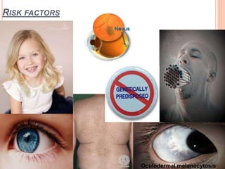 RISK FACTORS
Oculodermal melanocytosis
 