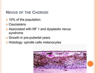 NEVUS OF THE CHOROID
 10% of the population.
 Caucasians
 Associated with NF 1 and dysplastic nevus
syndrome
 Growth in pre-pubertal years
 Histology: spindle cells melanocytes
 