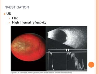 INVESTIGATION
 US
• Flat
• High internal reflectivity
 