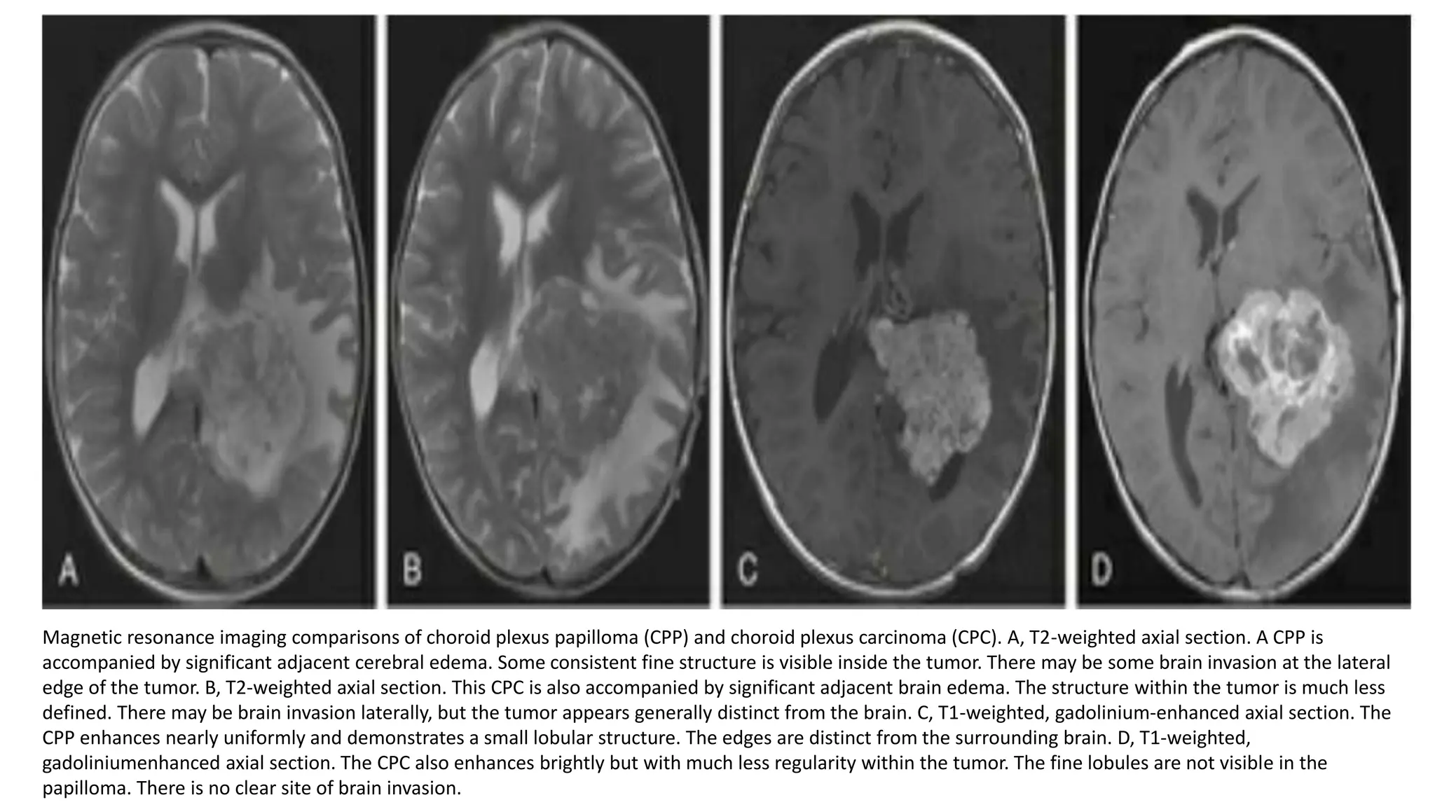 CHOROID PLEXUS PAPILLOMAS Presentation.. | PPTX