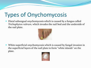 Types of OnychomycosisDistal subungual onychomycosis which is caused by a fungus called Trichophyton rubrum, which invades the nail bed and the underside of the nail plate.White superficial onychomycosis which is caused by fungal invasion in the superficial layers of the nail plate to form “white islands” on the plate.