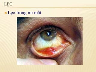 chắp lẹo mộng mắt 2.pdf