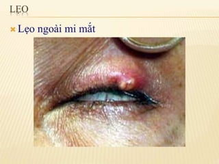 chắp lẹo mộng mắt 2.pdf