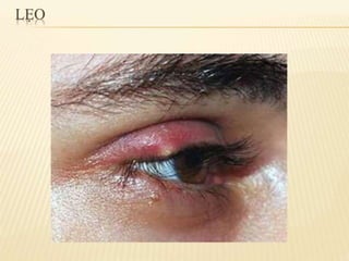 chắp lẹo mộng mắt 2.pdf