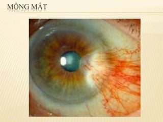 chắp lẹo mộng mắt 2.pdf