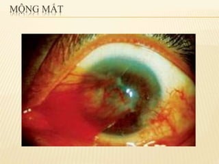 chắp lẹo mộng mắt 2.pdf