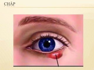 chắp lẹo mộng mắt 2.pdf