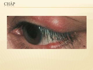 chắp lẹo mộng mắt 2.pdf