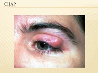 chắp lẹo mộng mắt 2.pdf