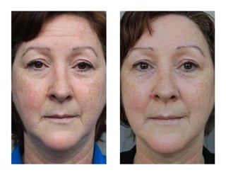 Christy Seven Days after using AgeLoc