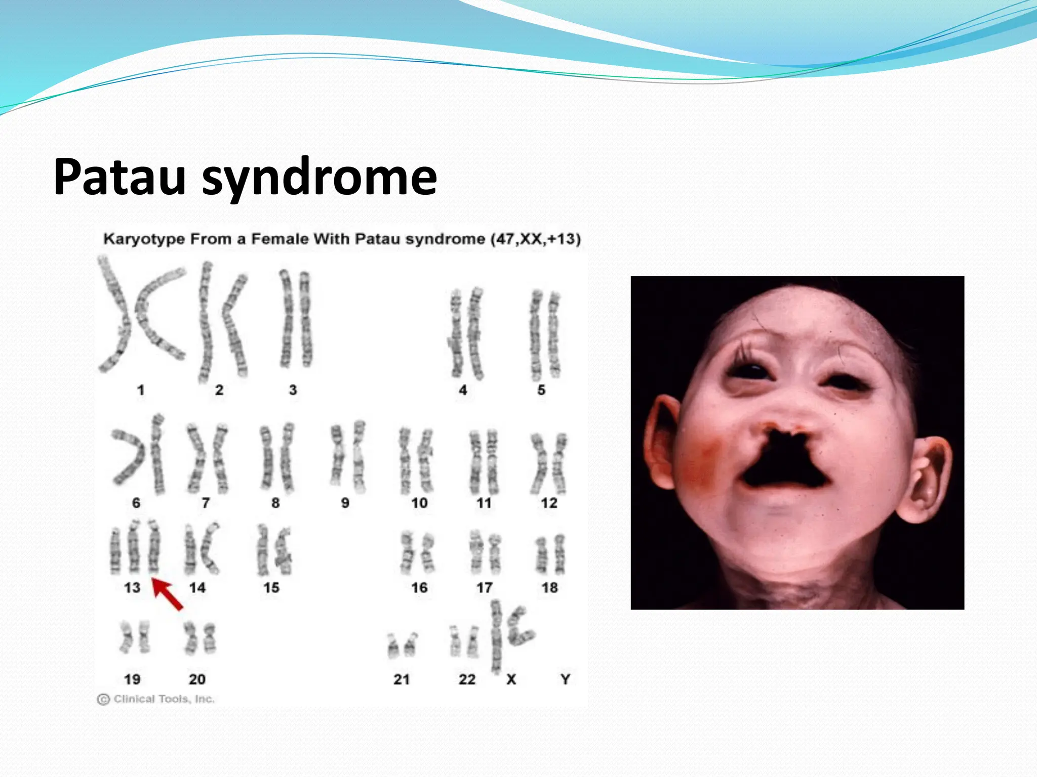 Patau syndrome
 